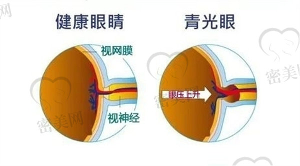 青光眼的发病原因