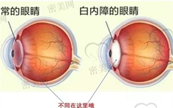 防止出现视网膜脱落