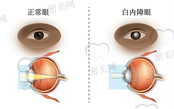 白内障囊外摘除术术后护理