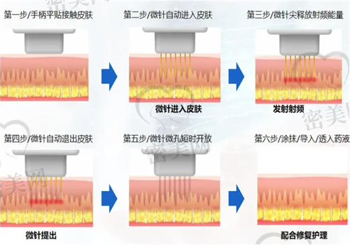 魔方电波拉皮和黄金微针的比较