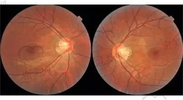 视网膜脱离多久会失明