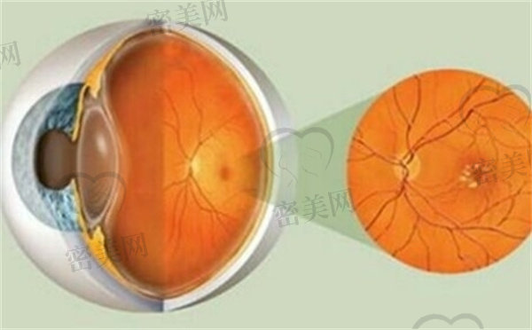 视网膜脱落怎么恢复