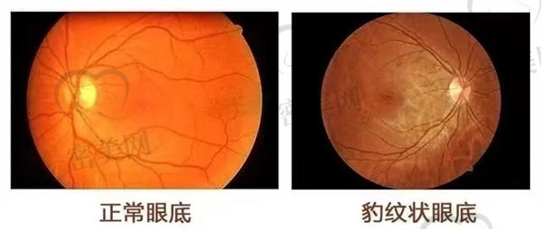 视网膜脱落手术