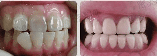 做过烤瓷牙还能做牙齿矫正吗