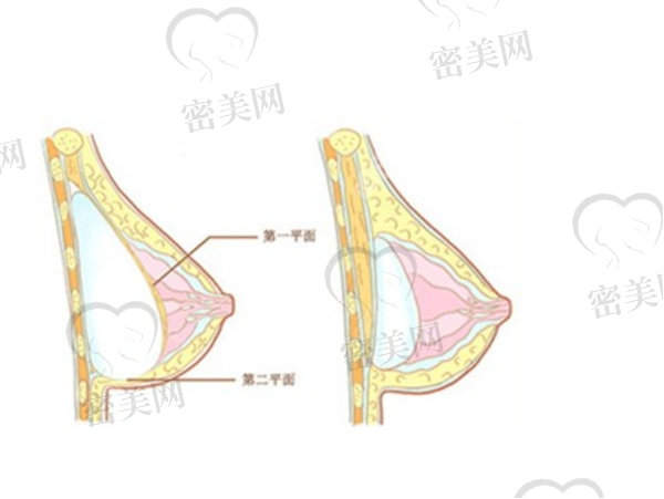 极速隆胸和普通隆胸的区别