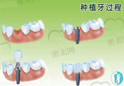 贵的种植牙与便宜种植牙的区别在哪