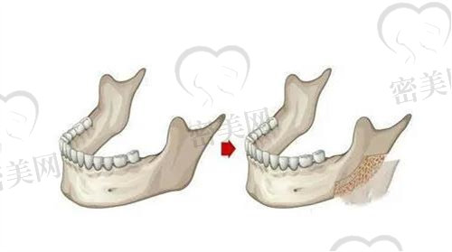 下颌骨皮质骨去除有必要吗