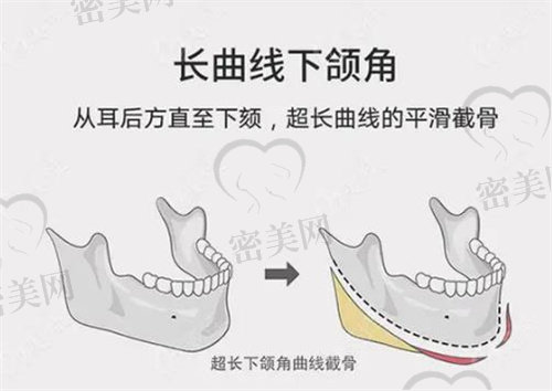 下颌骨去骨皮质术是什么