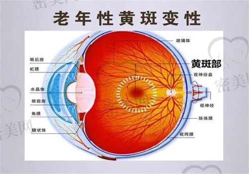 黄斑变性有几种类型