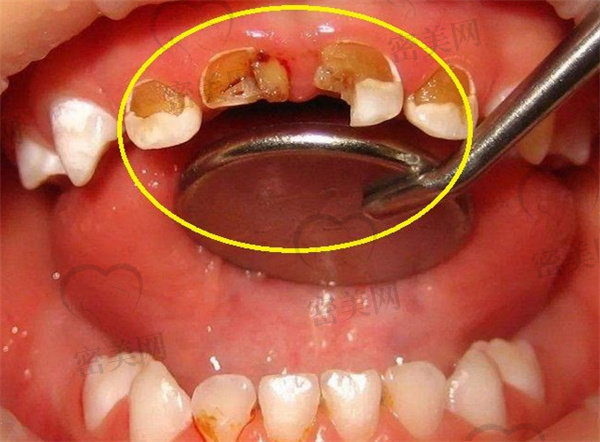 4岁小孩蛀牙已经烂空了怎么办