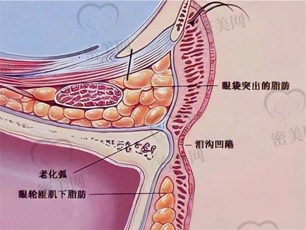 胶原蛋白为啥适合填充泪沟呢