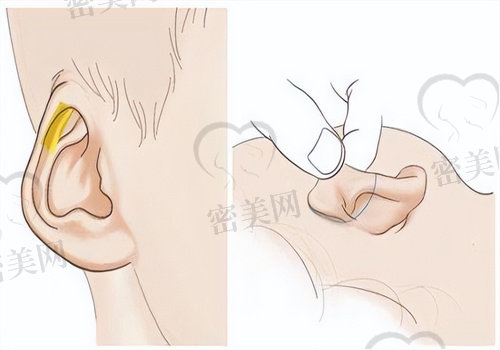 先天性耳道闭锁一般能治好