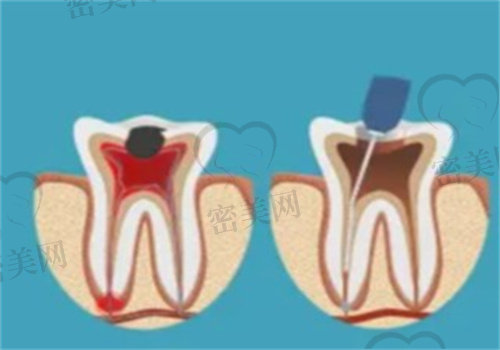 显微根管治疗和根管治疗的区别是什么