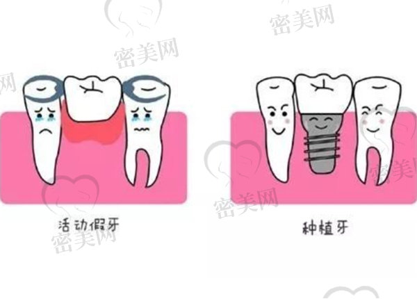 老年人牙齿掉了是镶牙好还是种牙好