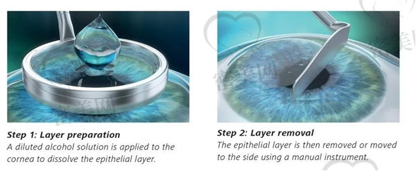 飞秒辅助个体化LASIK