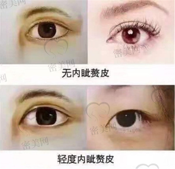 去内眦赘皮和开眼角一样吗