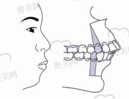 正颌手术单颌和双颌有啥区别?