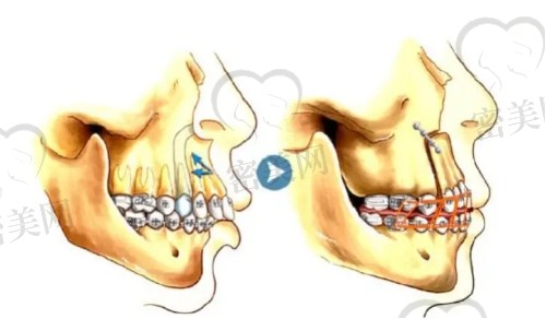 正颌手术单颌和双颌有啥区别?