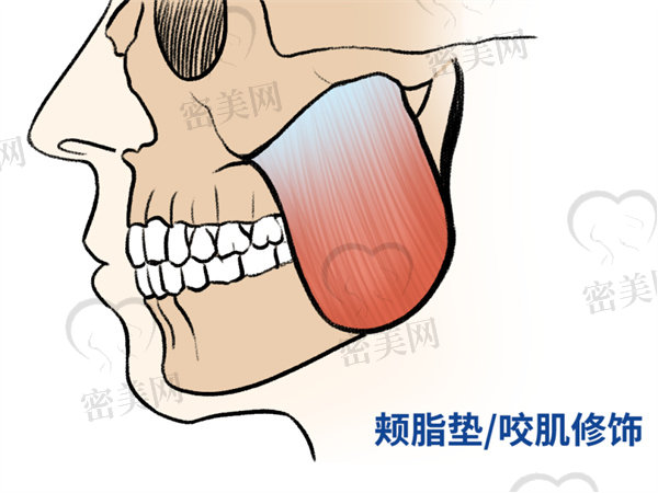 长曲线下颌角截骨术后多久能恢复