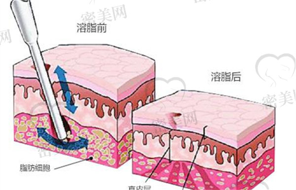 激光无.创溶质技术会留疤吗