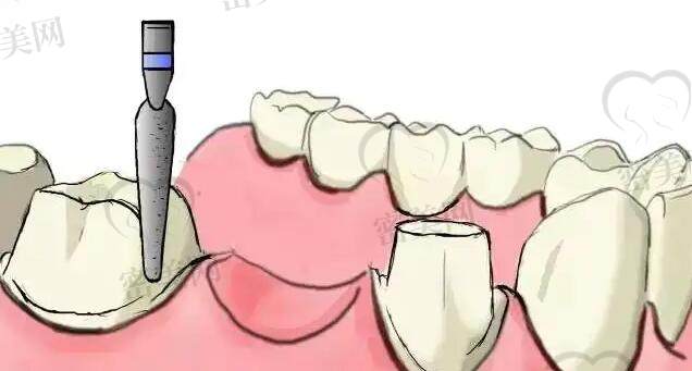 牙博士口腔种植牙多少钱一颗