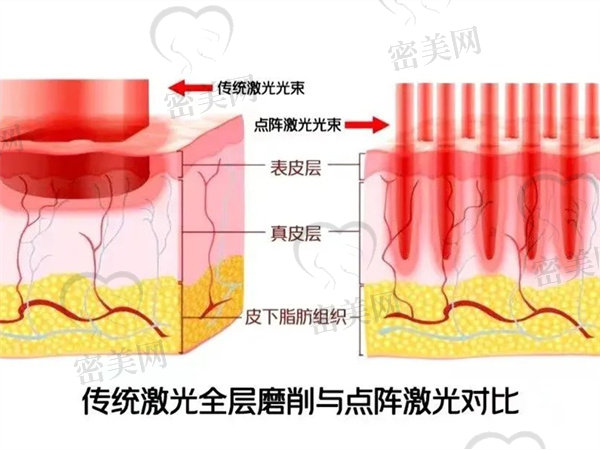 点阵激光治疗痘坑