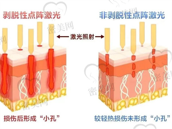 点阵激光治疗痘坑