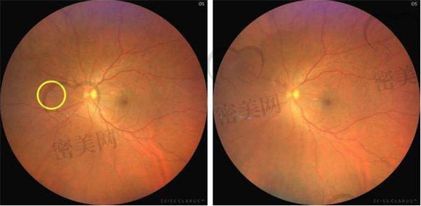 视网膜中央动脉阻塞是什么