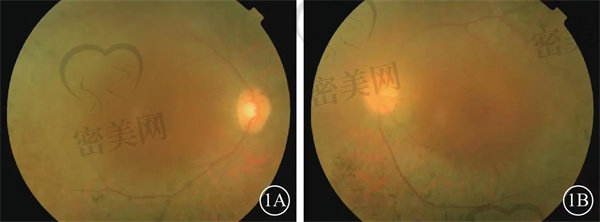 视网膜中央动脉阻塞的治疗原则