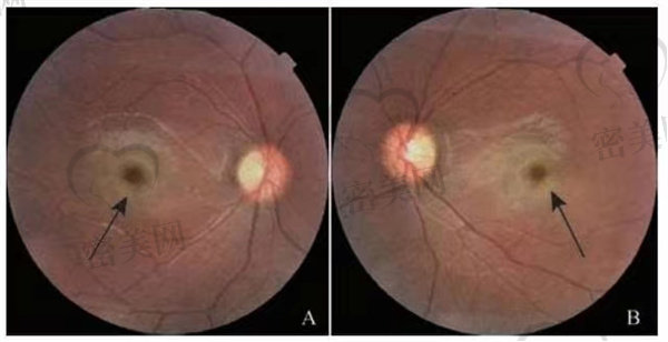 视网膜中央动脉阻塞的预防与修复