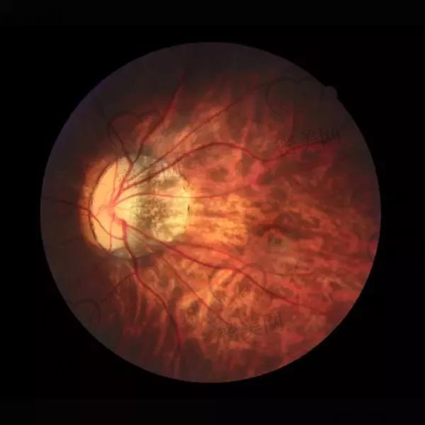 视网膜中央动脉阻塞