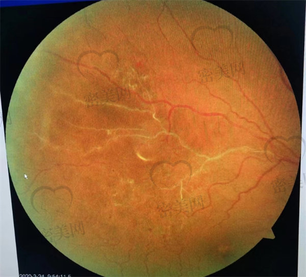眼底荧光血管造影和吲哚菁绿造影两种检查方法适应症
