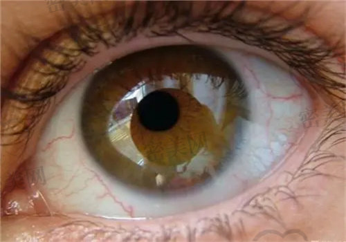 眼压高能做近视手术吗