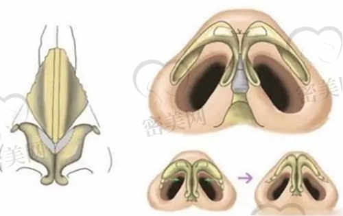 西安画美整形医院隆鼻口碑分享