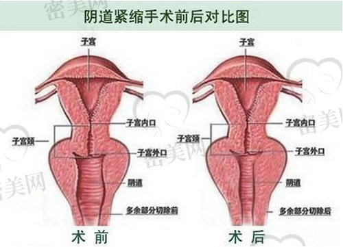 紧缩针长沙哪里可以打 紧缩针长沙哪里可以打
