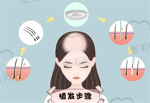 北京眉毛种植哪家医院好