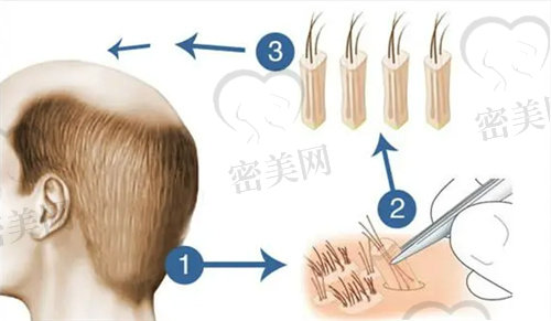 北京眉毛种植哪家医院好