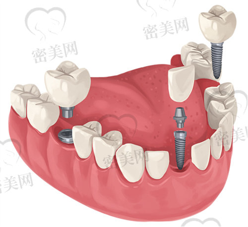 北京中诺口腔医院种牙价格表