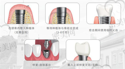 北京中诺口腔医院种牙价格表