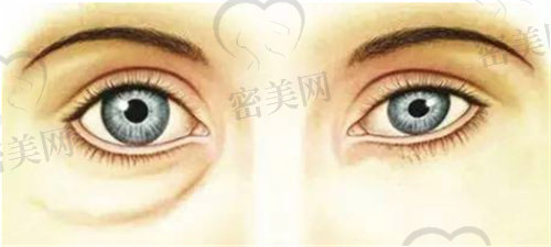 成都健丽医美去眼袋怎么样