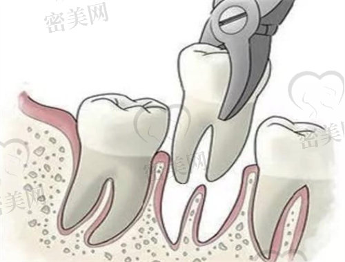 正规医院拔智齿价格表