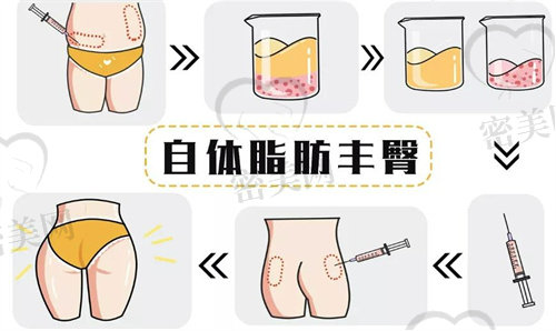 北京脂肪填充专门医院排名榜