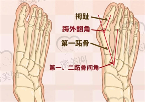 兰州大脚骨手术哪家医院好