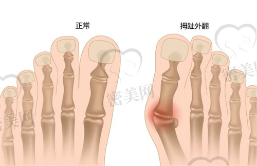 兰州大脚骨手术哪家医院好