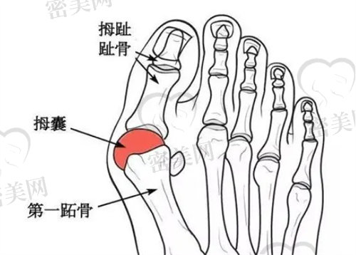 兰州大脚骨手术哪家医院好