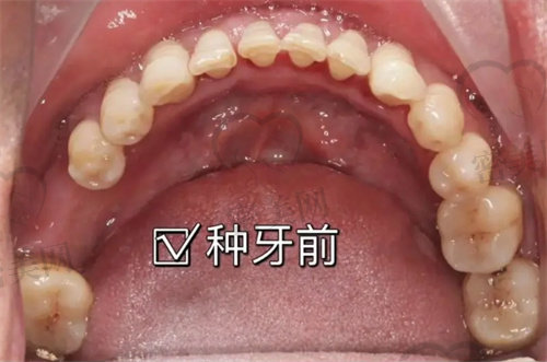 南京市口腔医院种牙多少钱一颗