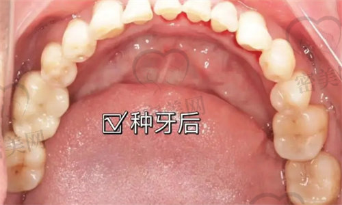南京市口腔医院种牙多少钱一颗