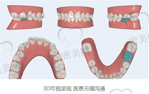 南京市口腔医院种牙多少钱一颗