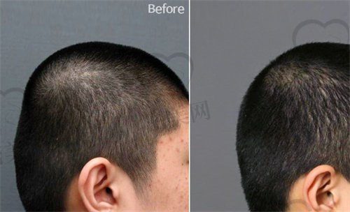 能做peek颅骨修补手术的医院 能做peek颅骨修补手术的医院