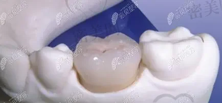2023天津金属牙冠齿科医院推荐前十(天津蓟州区合心口腔医院技术与口碑都有！)
